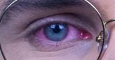 Olhos vermelhos, coçando e inchados: conjuntivite ou blefarite?