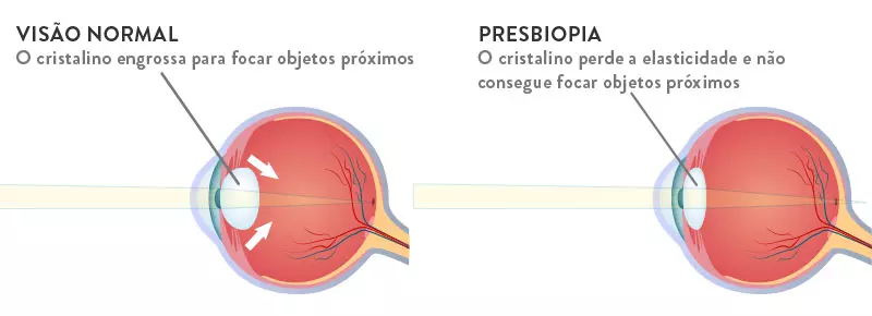 esquema-olho-visao-normal-presbiopia